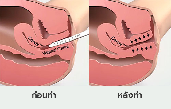 รีวิวการดูแลช่องคลอด รีแพร์โดยใช้เครื่องกระชับฟิต